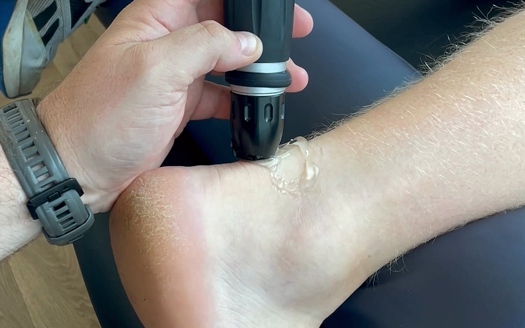 A shockwave therapy handpiece applied to a patient's Achilles tendon with contact gel.